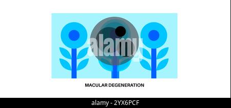 Makuladegeneration, Illustration. Stockfoto