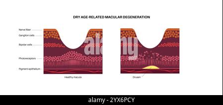 Trockene Makuladegeneration, Illustration. Stockfoto