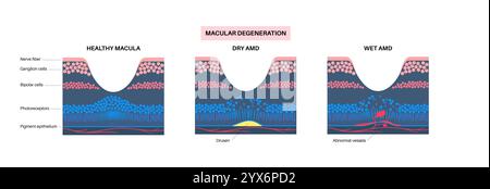 Nasse und trockene Makuladegeneration, Illustration. Stockfoto