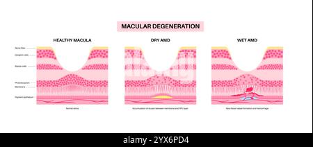 Nasse und trockene Makuladegeneration, Illustration. Stockfoto