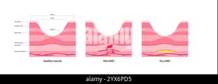 Nasse und trockene Makuladegeneration, Illustration. Stockfoto