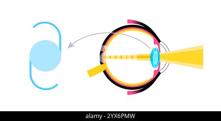 Intraokulare Linsenimplantation, Illustration. Stockfoto