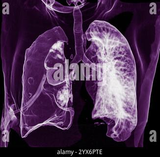 Farbige 3D-Computertomographie (CT)-Untersuchung des Thorax eines 60-jährigen männlichen Patienten mit Pneumothorax oder Lungenkollaps. Die rechte Lunge (links gesehen) ist aufgrund einer Luftansammlung zwischen Lunge und Brustwand zusammengebrochen. Ein Pneumothorax kann durch ein Trauma oder eine Lungenruptur verursacht werden. Es verursacht Kurzatmigkeit und Schmerzen beim Atmen. Es wird behandelt, indem ein Schlauch eingeführt wird, um die Luft über einen Zeitraum von Tagen abzulassen, sodass sich die Lunge wieder aufblasen kann. Stockfoto