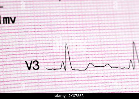 EKG-EKG-Schreiber, eine Tabelle, die die Elektrizität des Herzens zeichnet und eine Vorstellung über den Herzzustand und den Rhythmus gibt und Angin ausschließt Stockfoto