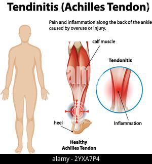 Diagramm mit Entzündung und Schmerzen der Achillessehne Stock Vektor