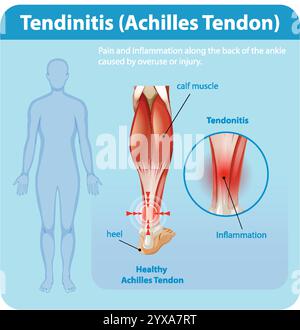 Diagramm mit Entzündung und Schmerzen der Achillessehne Stock Vektor