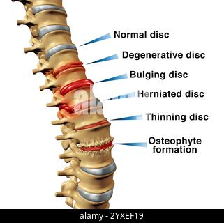 Wirbelsäulenerkrankungen Rückenschmerzen Konzept mit degenerativer Bandscheibe oder Ausbuchtung und Bandscheibenvorfall und Osteophytenbildung an einem Skelettwirbel AS Stockfoto