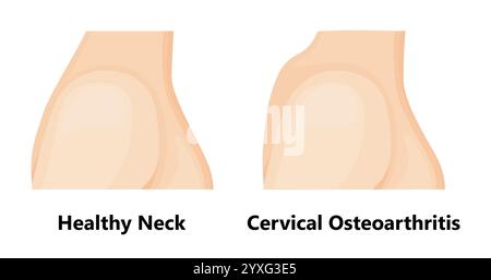 Zervikale Osteochondrose und gesunder Hals. Stock Vektor