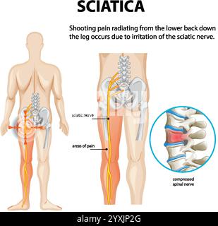 Illustration von Ischiasnervenschmerz und Wirbelsäulenkompression Stock Vektor