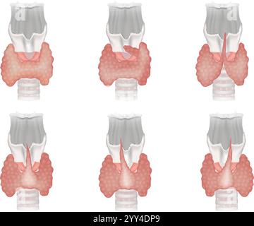 Pyramidenlappenveränderungen in Schilddrüsenanatomie und Pyramidenlappen. Klassifikation der Schilddrüsenformen. Schilddrüsenanatomie-Ausbildung Stock Vektor