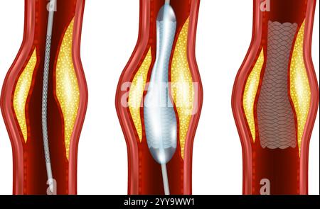 Abbildung Des Angioplastie-Verfahrens. Ballonangioplastie Schritt für Schritt. Arterienstentplatzierung. Arterienverengung. Stock Vektor