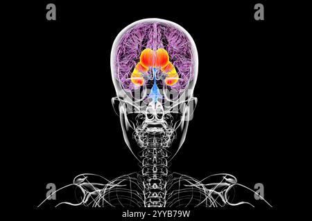 Computerdarstellung der vergrößerten lateralen Ventrikel (Hydrozephalus) des Gehirns. Stockfoto