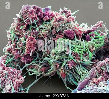 Plakette - Bakterien, Farbig Scanning Electron Micrograph (SEM). Plaque besteht aus einem Film von Bakterien in einem glykoprotein Matrix eingebettet. Die Matrix ist eine bakterielle Sekrete und Speichel gebildet. Zahnbelag ist die Hauptursache für Karies. Die Bakterien ernähren sich von Zucker in der Nahrung, die Säure als Abfallprodukt. Diese Säure greift die Zähne emailbeschichtung, was zu Karies. Die Ansammlung von Zahnbelag kann auch entzündete und infizierten Zahnfleisch führen. Schwere Zahnfleischerkrankungen können Zähne herausfallen führen. Vergrößerung: x2000 bei 10 Zentimeter gedruckt Stockfoto