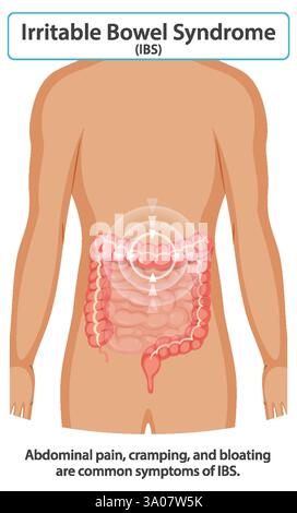 Abbildung der Symptome des RDS und der betroffenen Bereiche Stock Vektor