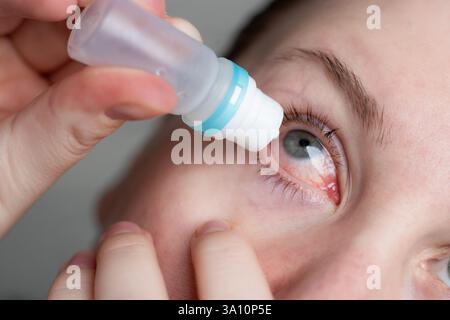 Nahaufnahme einer Frau, die Augentropfen auf rot infiziertes Auge mit Bindehautentzündung zu Hause aufträgt Stockfoto