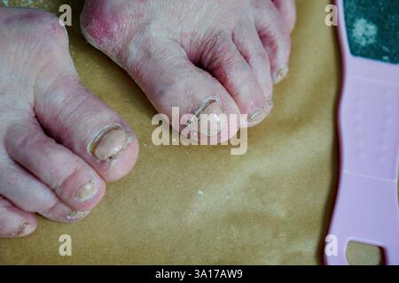 PilzZehennägel vor Pediküre-Behandlung. Hochwertige Fotos Stockfoto