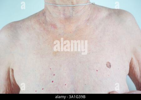 Muttermale und Haut versteckte Gefahren auf der Haut älterer Frauen. Hochwertige Fotos Stockfoto