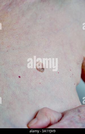Muttermale und Hautkrebs versteckte Gefahren auf der Haut älterer Frauen. Hochwertige Fotos Stockfoto