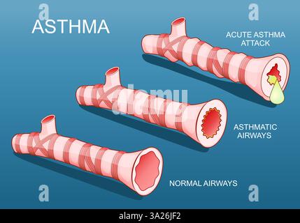 Asthma. Entzündliche Erkrankungen der Atemwege der Lunge. Normale Bronchiolen und Bronchiolen während eines Asthmaanfalls, wenn die Atemwege anschwellen und voll sind Stock Vektor