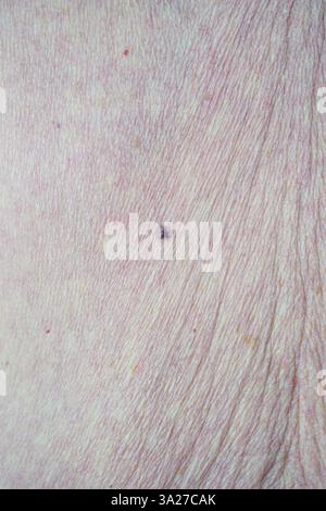 Muttermale und Hautkrebs versteckte Gefahren auf der Haut älterer Frauen. Hochwertige Fotos Stockfoto