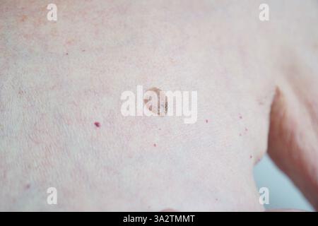 Muttermale und Hautkrebs versteckte Gefahren auf der Haut älterer Frauen. Hochwertige Fotos Stockfoto