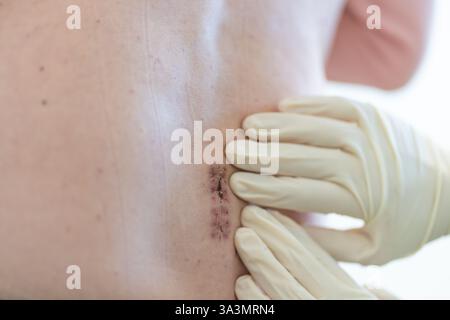 Facharzt in Handschuhen zur Untersuchung des Heilschnitts am Rücken des Patienten, zur Beurteilung des Wundzustandes und des Erholungsfortschritts mit sorgfältiger Beurteilung Stockfoto