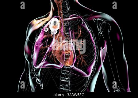 Illustration der Hohlraumtuberkulose im Oberlappen der rechten Lunge, des Organs, der Organe, mit Lungenschäden und -Hohlräumen. Stockfoto