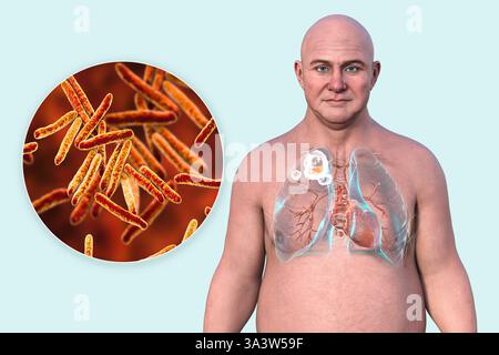 Illustration eines Mannes mit Lungen, die von Kavituberkulose im rechten Oberlappen betroffen sind, mit Lungenschäden und -Hohlräumen sowie Nahaufnahme von Mycobacterium tuberculosis-Bakterien. Stockfoto