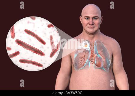 Illustration eines Mannes mit Lungen, die von Kavituberkulose im rechten Oberlappen betroffen sind, mit Lungenschäden und -Hohlräumen sowie Nahaufnahme von Mycobacterium tuberculosis-Bakterien. Stockfoto