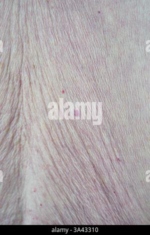 Nahaufnahme einer älteren weiblichen Haut mit mehreren Muttermalen, Pigmentierungsunregelmäßigkeiten und potenziellen Warnzeichen für Hautkrebs. Das Bild hebt Abweichungen in Größe, Form und Farbe der Muttermale hervor und unterstreicht die versteckten Gefahren von Melanomen und anderen dermatologischen Zuständen. Diese medizinische Darstellung unterstützt Konzepte in der Dermatologie, Hautpflege-Bewusstsein und medizinische Diagnostik und zeigt die Bedeutung von Früherkennung und professionellen Hautuntersuchungen. Stockfoto