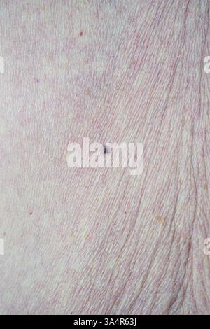 Muttermale und Hautkrebs versteckte Gefahren auf der Haut älterer Frauen. Hochwertige Fotos Stockfoto