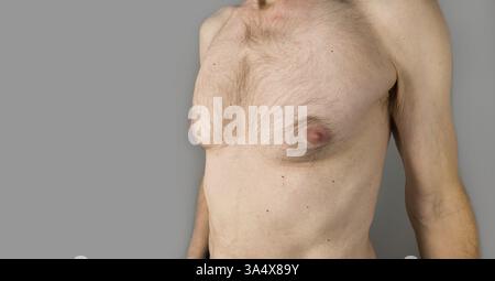 Die Hautkrankheit der Cherry-Angiome. Geweitete Gefässe an einem Reifen Mannskörper Stockfoto