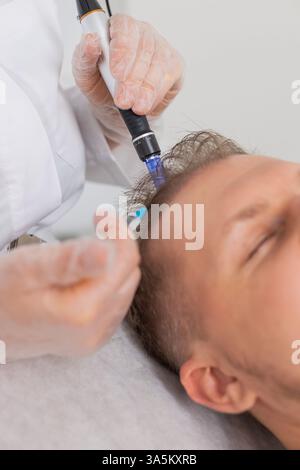 Alopezie. Der Haarausfall des Mannes verbessert die Regeneration der Wachstumsbehandlung, Dermapen-Mikroneedling, Vitamin-Exosomen-Plasmainjektionen. Trichologe Kosmetologe Arzt KopfKopfKopfhautverfahren fraktionelle Mesotherapie Stockfoto