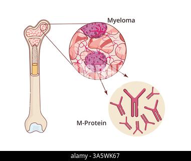 Myelompathologie-Illustration. Darstellung eines Knochenmarks mit karzinombildendem M-Protein Stockfoto