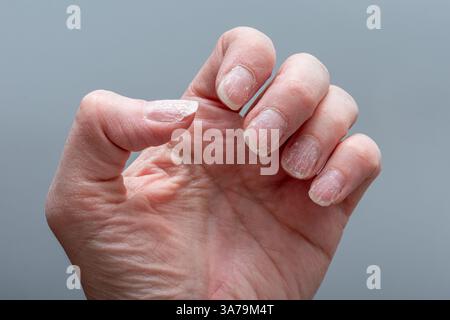 Detaillierte Nahaufnahme einer Hand, die spröde, trockene und abblätternde Nägel zeigt, mit dehydrierter Haut auf einem neutralen grauen Hintergrund. Konzept der Nagelgesundheit. Negati Stockfoto