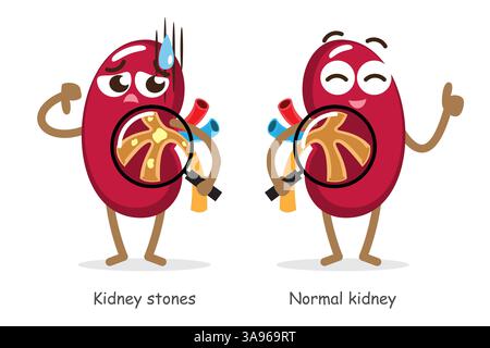 Nierensteine und normale Niere. Lustige Cartoonfiguren der medizinischen Nieren. Isolierter weißer Hintergrund. Vektor . Stock Vektor