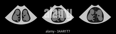 Drei Ultraschallbilder, die verschiedene Stadien der Entwicklung von Zwillingsfeten während der Schwangerschaft zeigen, zeigen Wachstum und Bewegung innerhalb der Gebärmutter Stock Vektor