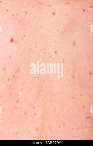 Nahaufnahme der Haut mit Sommersprossen, die die Bedeutung regelmäßiger Hautuntersuchungen und des Bewusstseins für die Prävention von Hautkrebs unterstreicht. Betont Gesundheit A Stockfoto