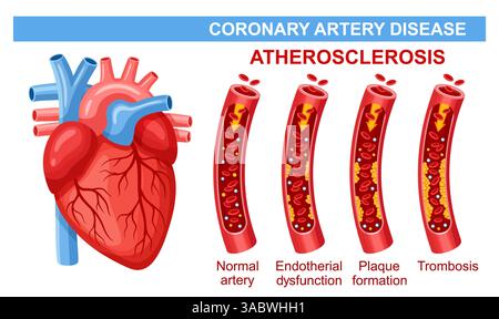 Koronare Herzkrankheit, arterielle Atherosklerose, Herzinfarkt, Block Blutgefäß Cholesterin. Kardiovaskuläre Systemthrombose. Kardiologische Gesundheit Stock Vektor