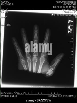 18. Dezember 2009 – Gilbert, Arizona, USA – Ärzte sagen, dass Timothy Blazer durch schnelles Denken seine linke Hand wieder befestigen konnte, nachdem er sie versehentlich mit einer Gehrungssäge durchtrennt hatte. Blazer, 52 Jahre alt, Schnitt ihm die linke Hand ab, während er an Schränken in seinem Haus in Gilbert, Arizona arbeitete. Nach dem Unfall hatte Blazer die Geistesgegenwart, seine abgetrennte Hand zu heben und sie auf Eis zu legen. Blazer sagt, dass sein Hintergrund bei den Pfadfindern und seine Ausbildung als Sicherheitsdirektor für Macy's ihm geholfen haben, ruhig zu bleiben. Chirurgen am Scottsdale Healthcare Hospital haben die Hand in einer vierstündigen Operation wieder befestigt und er hat Bewegung in allen Stockfoto
