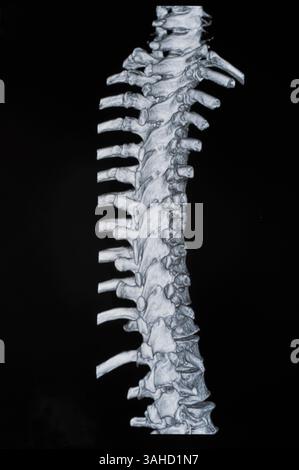 Spinale mrt-Bilder Stockfoto