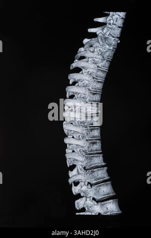 Spinale mrt-Bilder Stockfoto