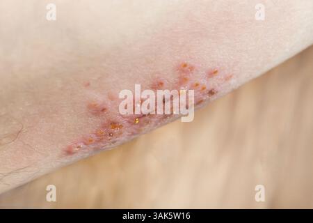 Frau mit Gürtelrose auf der Haut fühlt sich sehr schmerzhaft an Stockfoto