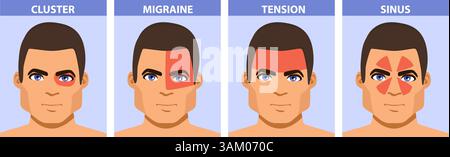 Infografik-Karikaturillustration eines Mannes mit farbkodierten Schmerzbereichen auf dem Kopf, die verschiedene Arten von Kopfschmerzen darstellen: Migräne, Cluster, Tensi Stock Vektor