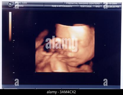 18. Mai 2004 - USA - KRT US NEWS STORY SLUGGED: MED-FETALULTRASOUND KRT FOTO VON CHRIS OCHSNER/KANSAS CITY STAR (23. Mai) ein Ultraschallbild von Julie und Steve Wards 28 Wochen altes Baby, aufgenommen bei Pränatal Imaging in Kansas City, Missouri. (Mvw) 2004 (Bild: © Chris Ochsner/mct/ZUMAPRESS.com) Stockfoto