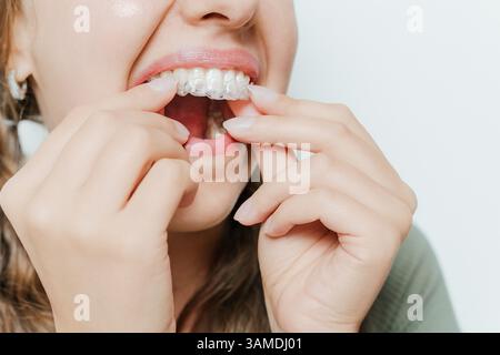 Nahaufnahme einer Frau, die mit beiden Händen einen transparenten ZahnAligner auf die oberen Zähne einführt, Zahnaufrichtung, Kieferorthopädie Stockfoto