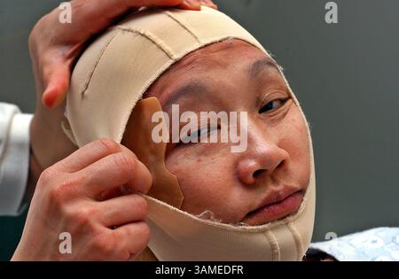 25. Februar 2002 - USA - (KRT1) KRT US NEWS STORY SLUGGED: ATTACKS-FORGOTTENVICTIMS KRT FOTO VON JOHN COSTELLO/PHILADELPHIA INQUIRER (8. März) Ling Young hat die Druckkleidung, die verwendet wird, um Narben zu minimieren, von ihrem Sohn Richard Young angepasst. Ling Young entkam aus dem Südturm des World Trade Centers kurz bevor er am 11. September 2001 zusammenbrach, wobei über 40 Prozent ihres Körpers verbrannt wurden. (PH) AP NC KD BL 2002 (Horiz) (gsb) (Kreditbild: © Philadelphia Inquirer/mct/ZUMAPRESS.com) Stockfoto