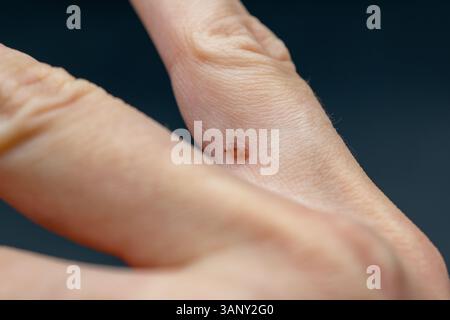 Papillom am Finger, häufige Warze Verruca vulgaris eine flache Warze an einer Hand, humanes Papillomavirus HPV Stockfoto