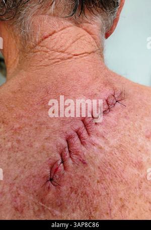 Diese Nahaufnahme zeigt eine frische chirurgische Narbe, die Entfernung des Melanoms auf dem Rücken eines Mannes, was den Heilungsprozess und die Reise in Richtung zeigt Stockfoto