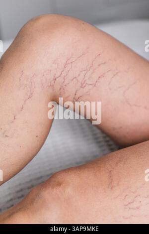 Porträt zeigt die Krampfadern an weiblichen Beinen, Falten und Spinne am Körper, Problem der Blutzirkulation der Reifen Frau, Gesundheit und Stockfoto